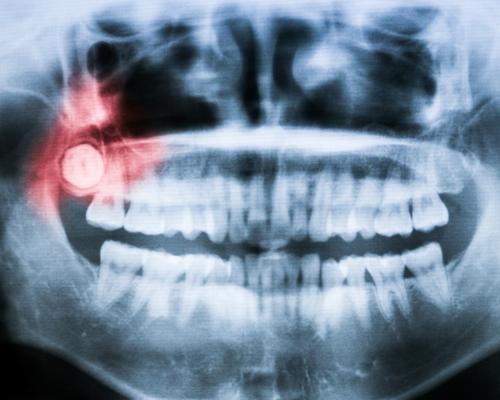 X-ray showing impacted wisdom tooth